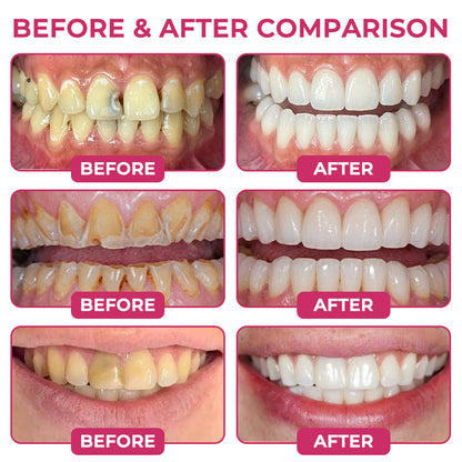 Cavity-Repair Natural Enamel Filling Gel